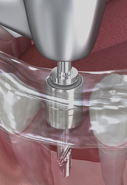 무절개 임플란트